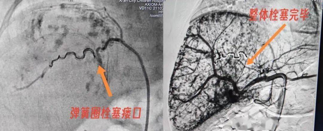 危！新生儿宝宝出现巨大肝脏血管瘤！-新生儿肝血管瘤会自行消退吗视频