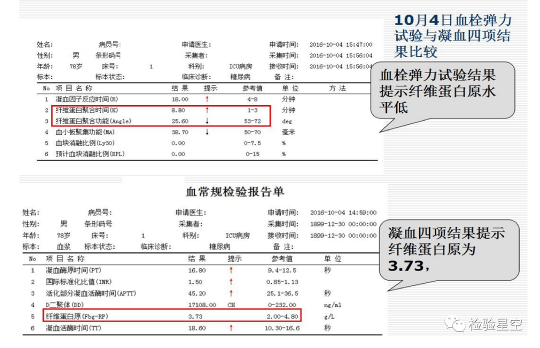 孕妇血栓弹力图ci值高图片