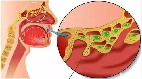 杭州女子的鼻子居然"发霉"了!霉菌和乒乓球一样大,还具侵蚀性!