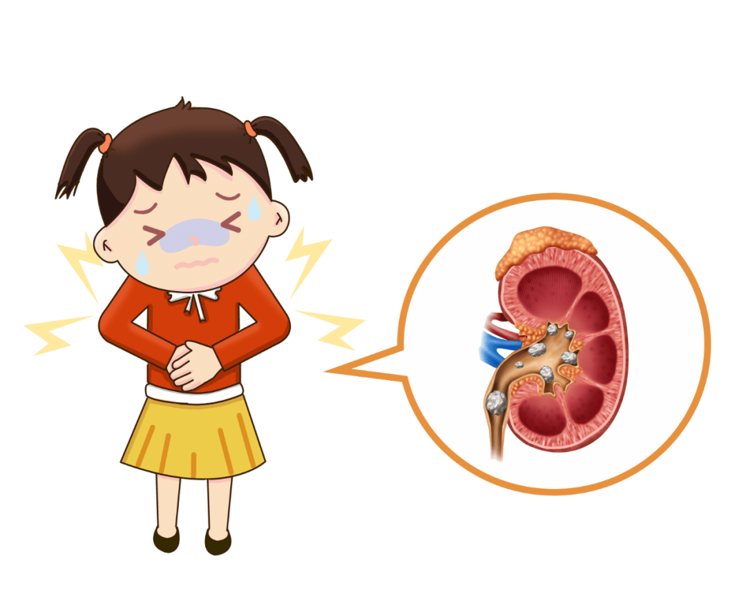 5岁女孩肾脏,输尿管多发结石,"双镜"联合一次性