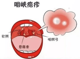 带您了解疱疹性咽峡炎