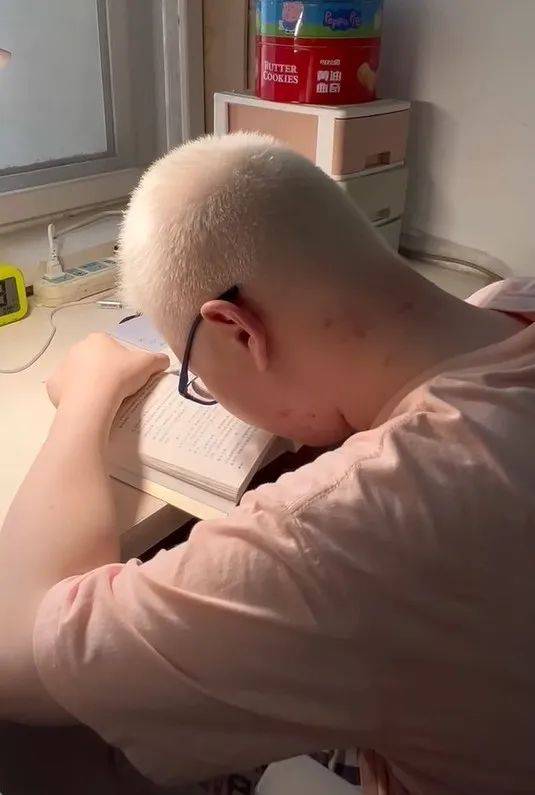 用望远镜上课,用放大镜看书,山东罕见病少年688分考上清华!