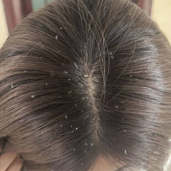 去头皮屑什么洗发水效果最好?止痒去头皮屑洗发水推荐