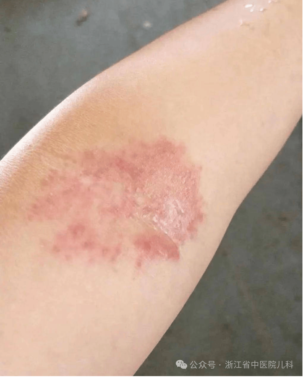 特异性皮炎系一组由于机体免疫系统对环境中典型