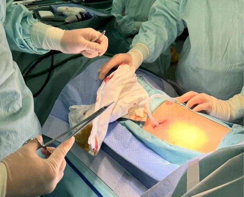 肺结节手术更微创,精准且高效:非插管,单孔胸腔镜结合