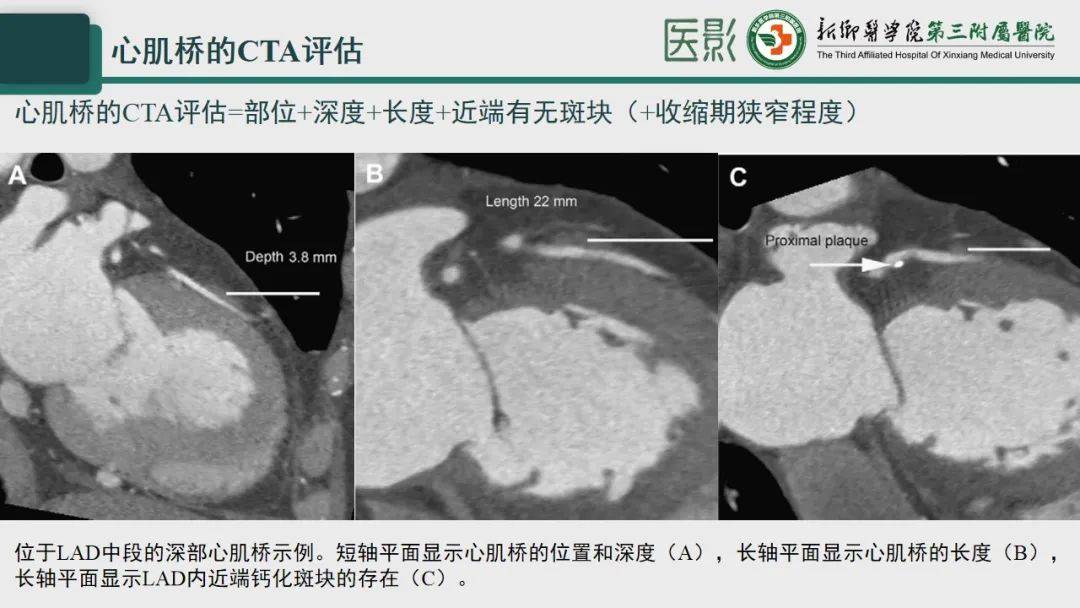 冠脉cta—心肌桥诊断要点