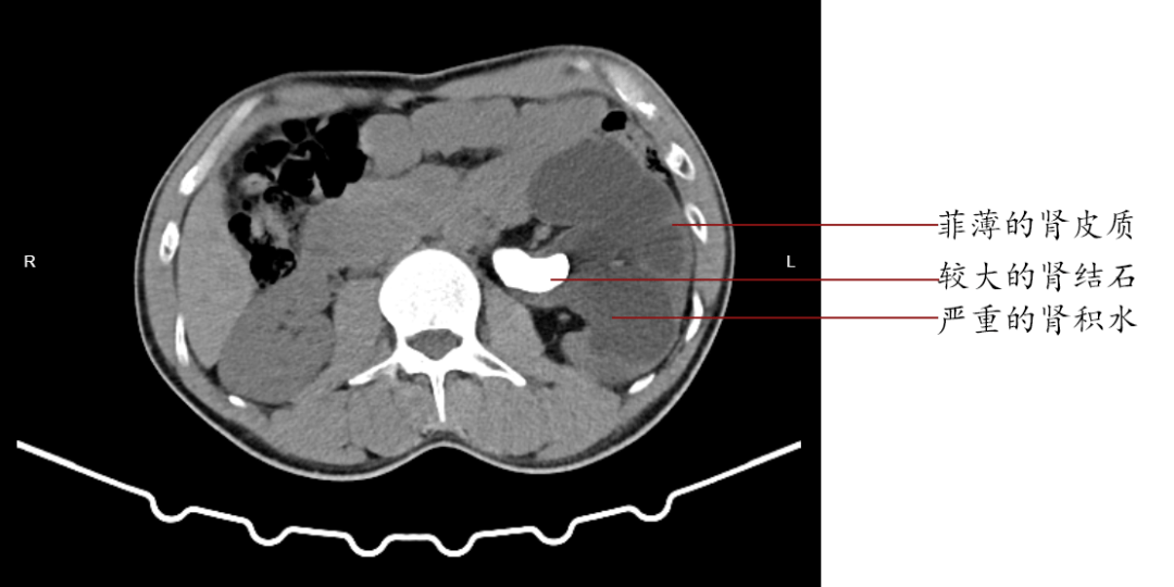 肾间隙图片