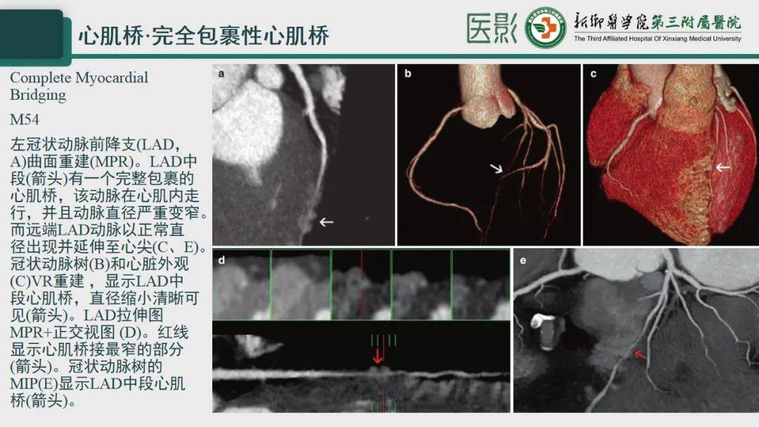 冠脉cta—心肌桥诊断要点