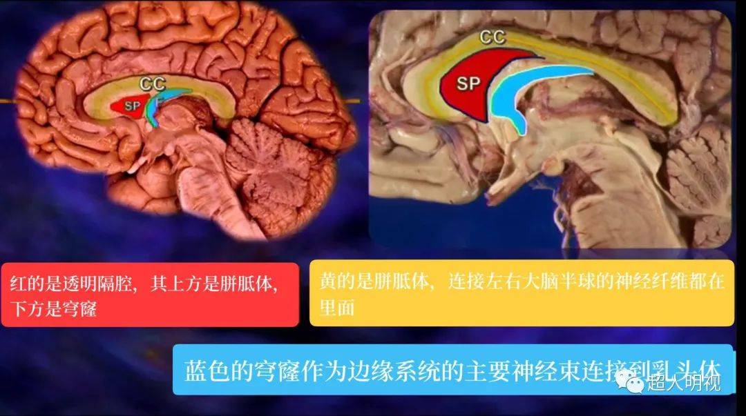 搞清楚透明隔腔和它周围结构极其重要_畸形_平面_解剖