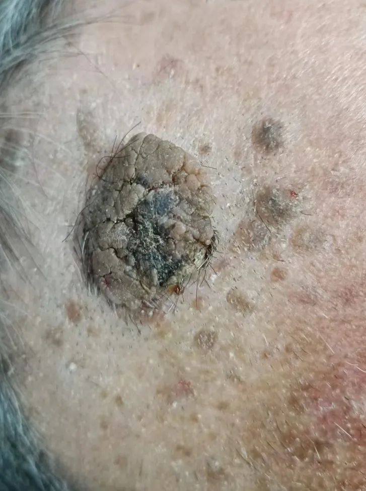 斑的"庐山真面目"其实呢,老年斑又称老年疣,医学上称为脂溢性角化病