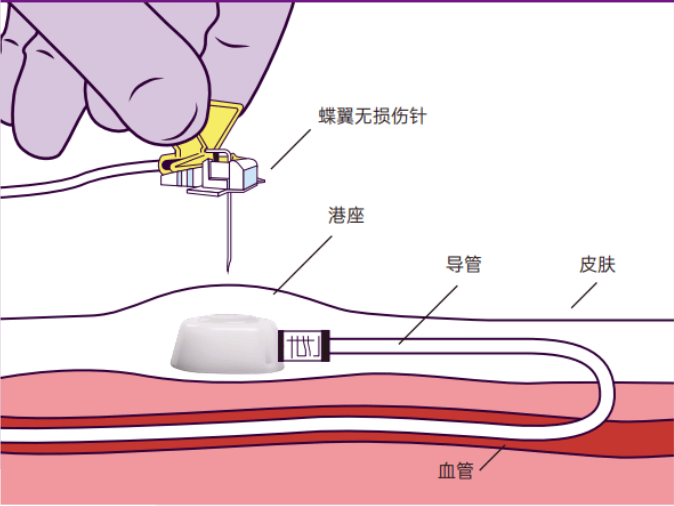 乳腺三针图片图片