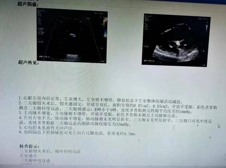 术后压差2mmhg术中2 术中1 术前心脏彩超3术前心脏彩超2 术前心脏彩超