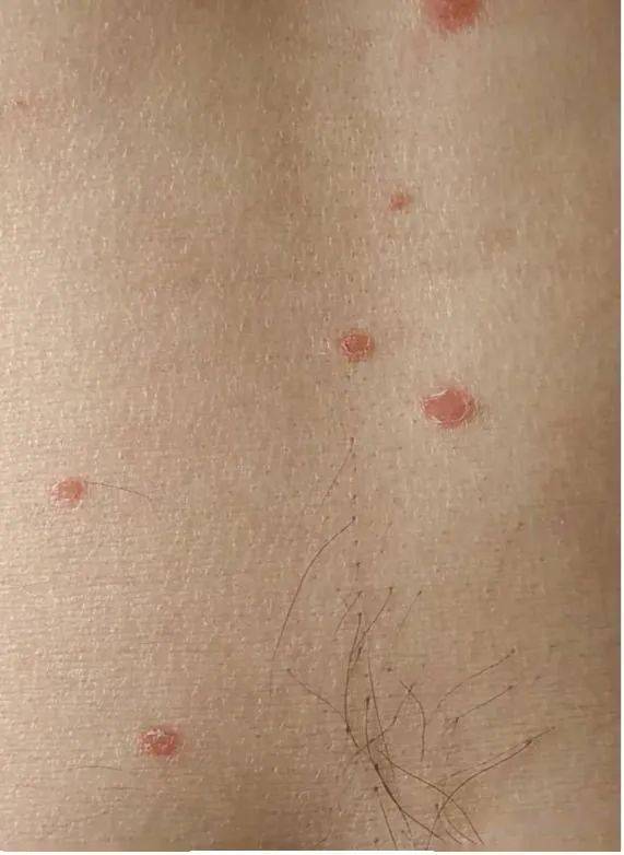 肝不好身上有红点图片，肝不好身上有红点图片肝炎早期症状