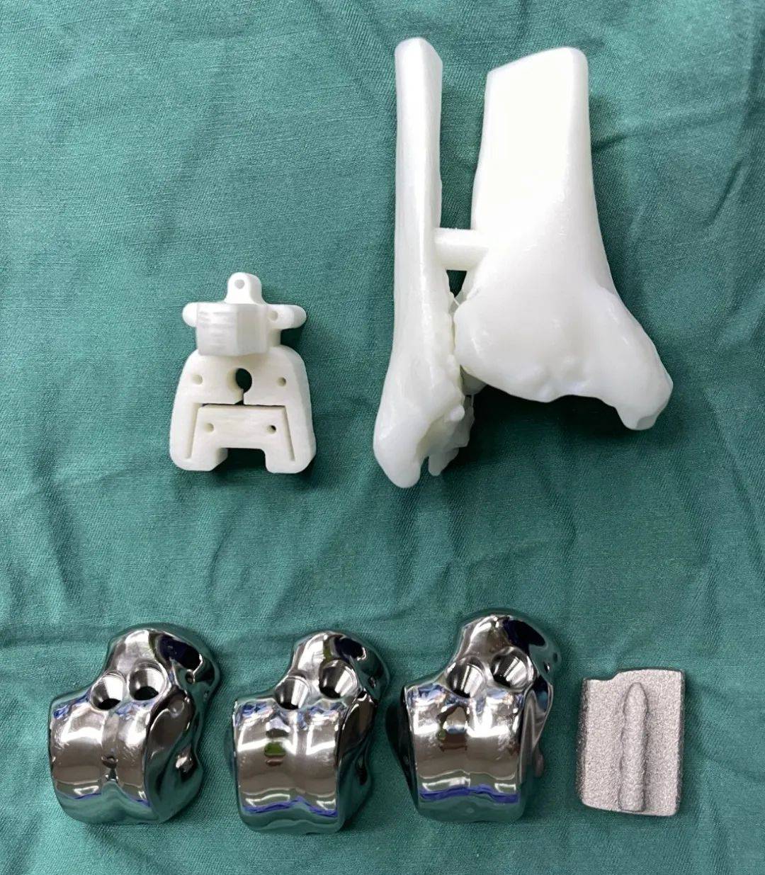 该患者踝关节存在骨关节炎,其胫骨关节面及距骨还都存在明显的骨囊肿
