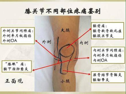 很多人在跑步之后发现膝盖痛,但这只是一个笼统的说法,其中涉及很多