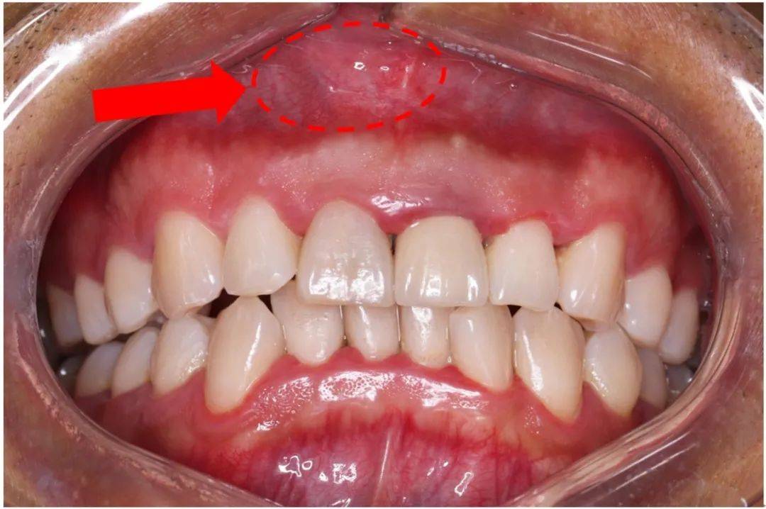 科普丨牙龈长包要重视,小心是根尖囊肿!