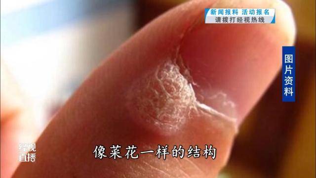 武汉一女子频繁美甲感染HPV 医生提醒：尽量避免做这种美容操作