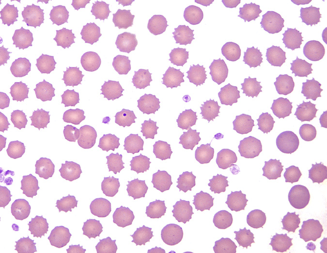 红细胞形态评估:异形红细胞之刺毛细胞,棘红细胞和裂红细胞