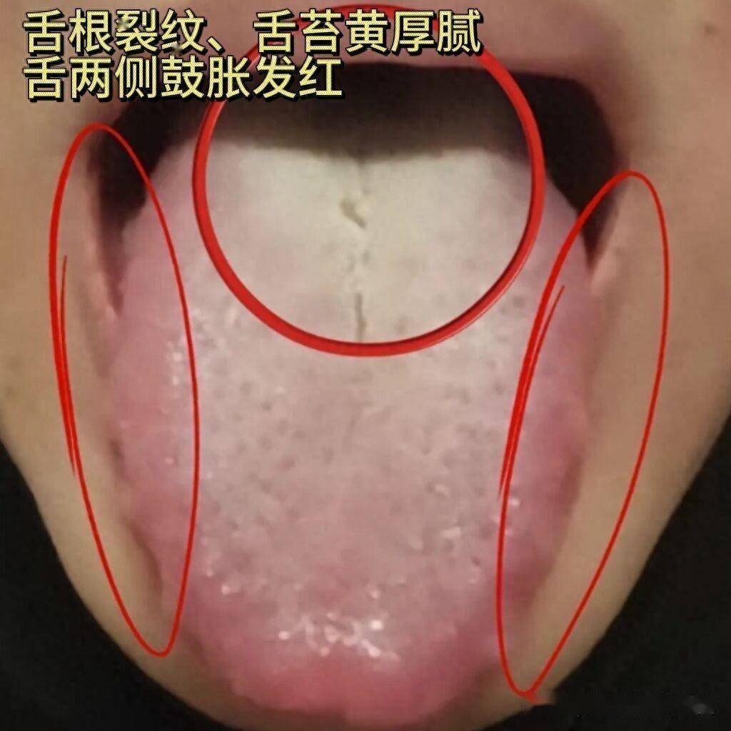 男性舌苔图片图片