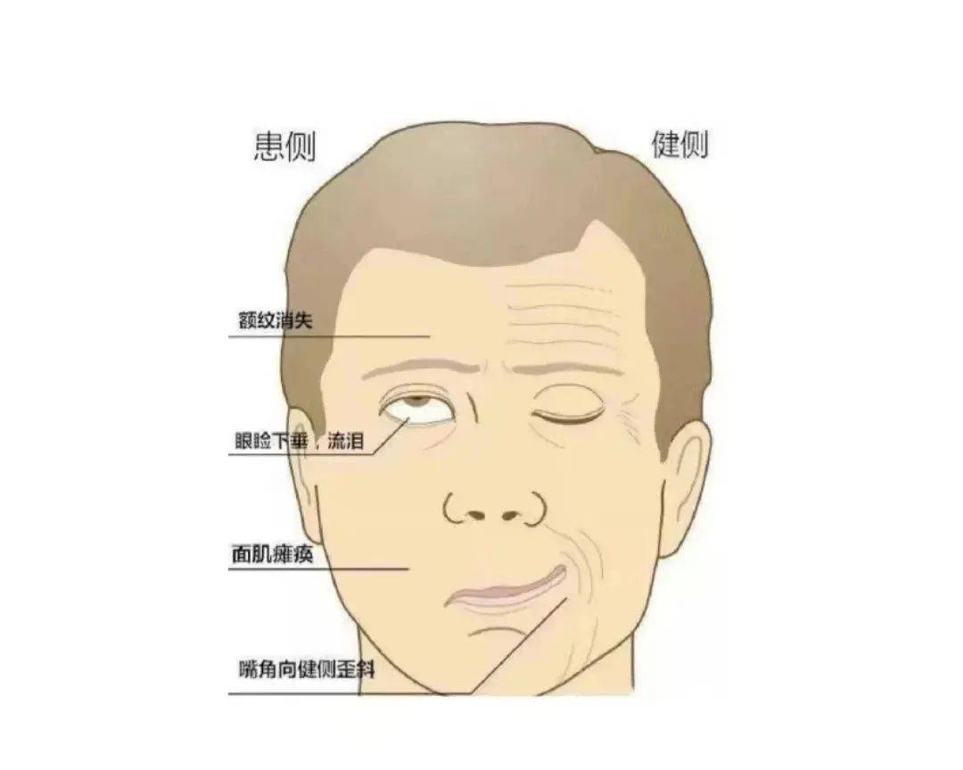 突然面瘫了,是中风前兆?医生:留心这些症状