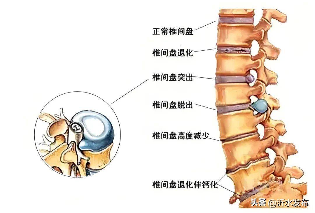 椎间盘部位图图片