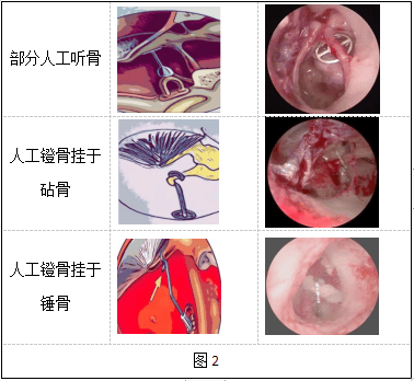 孩子从小听力不好,要当心听小骨畸形