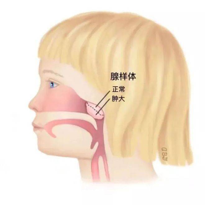 和腺样体肥大有什么关系?