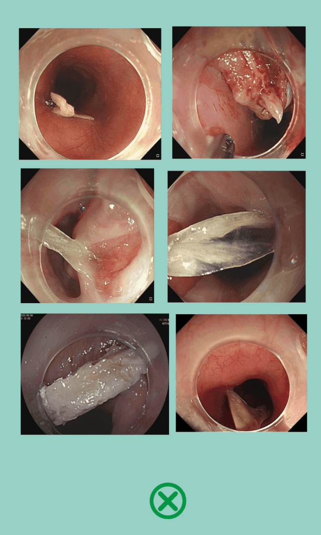 一口"入魂"还是"卡喉"?家常便饭中的安全指南
