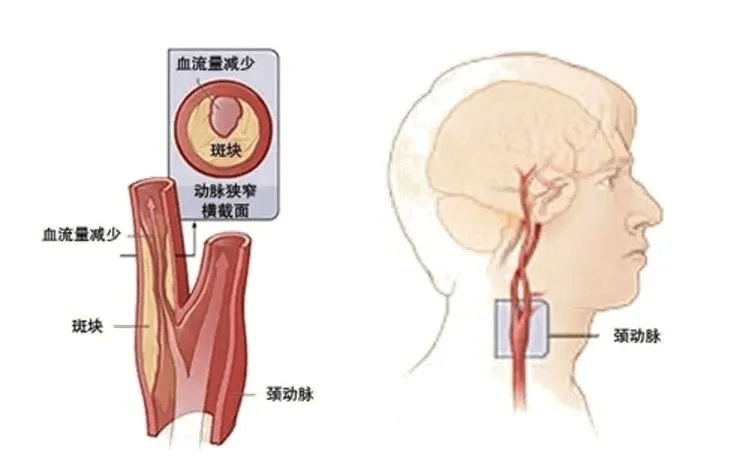 脑动脉瘤介入治疗图解图片