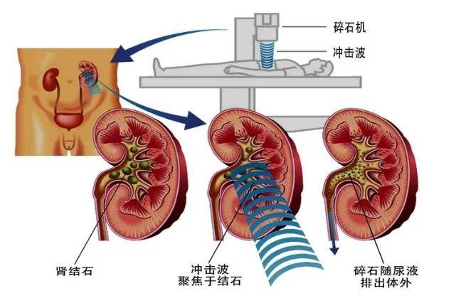 肾结石排出过程图图片