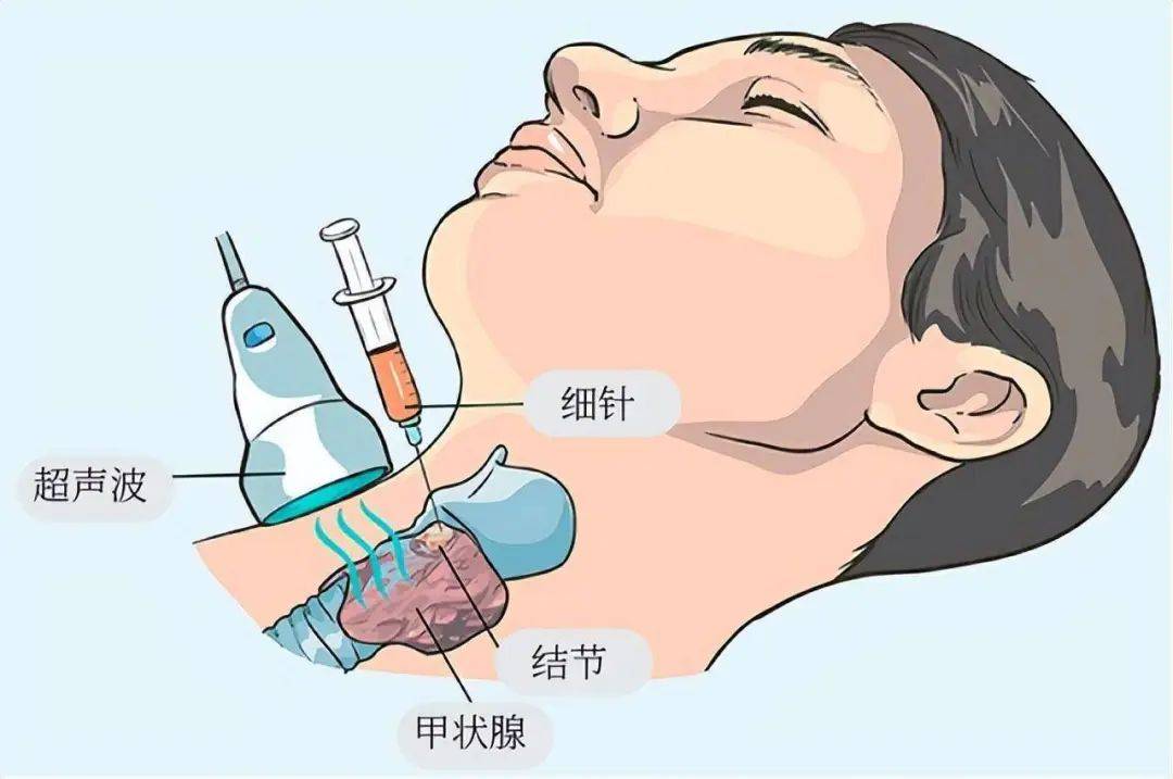 穿刺活检针原理演示图图片