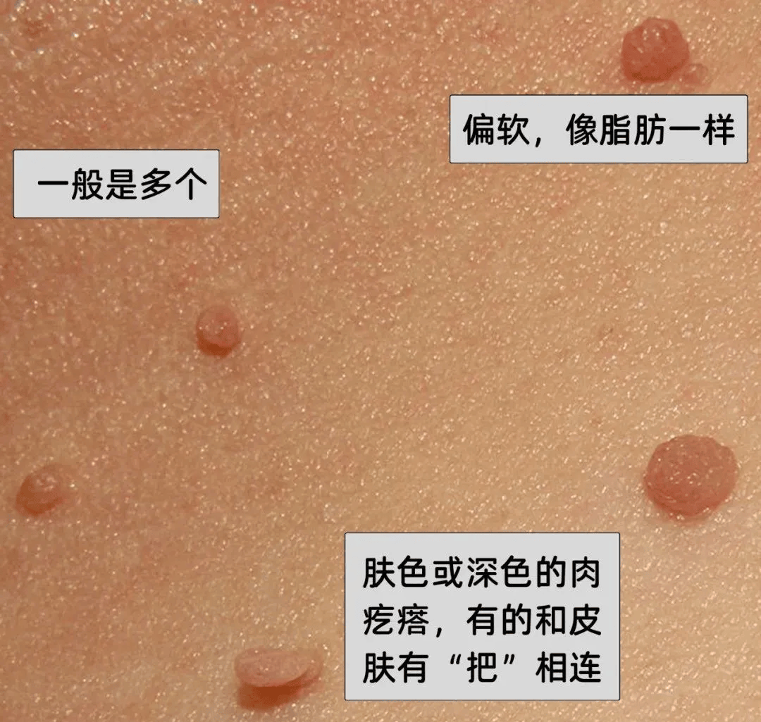 婴儿乳房旁边长肉粒图片