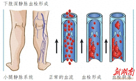 警惕健康的“隐形杀手”——静脉血栓!_血管_血液_弹力袜