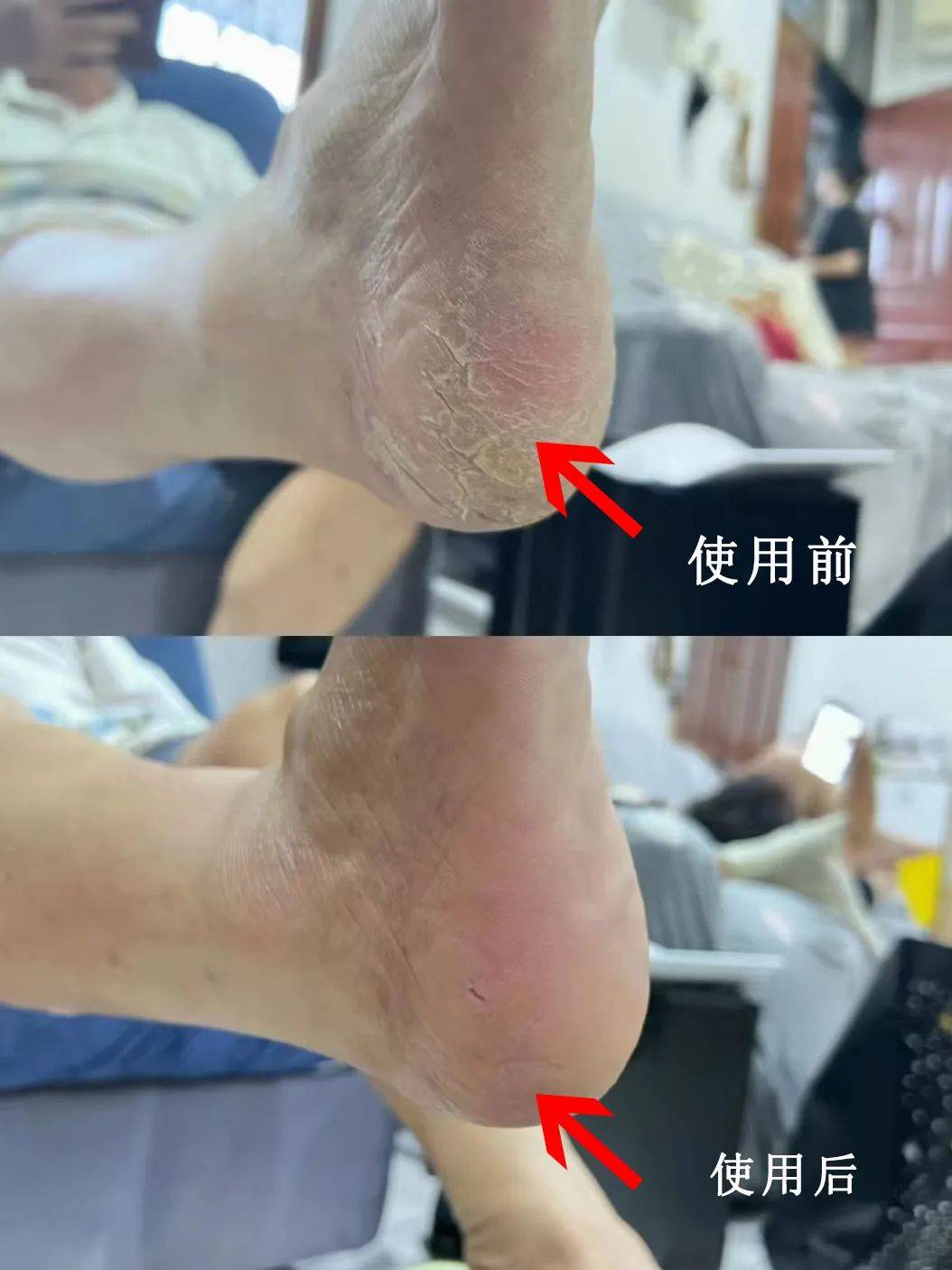 脚后跟干裂,小腿长"鱼鳞"?抹点它,还你光滑肌