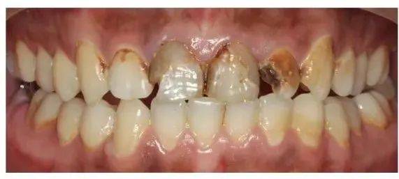 每天一杯奶茶,女生烂了12颗牙!