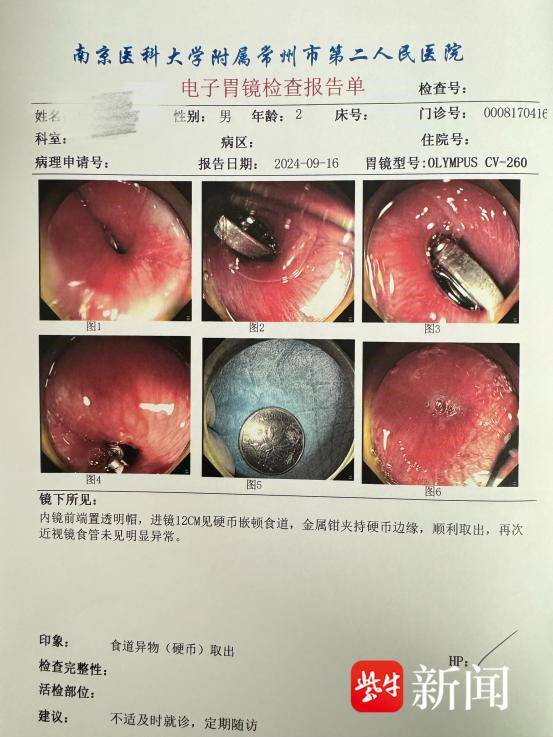 消化内科副主任医师范丽立即为孩子完善ct检查,结果显示硬币卡在食道