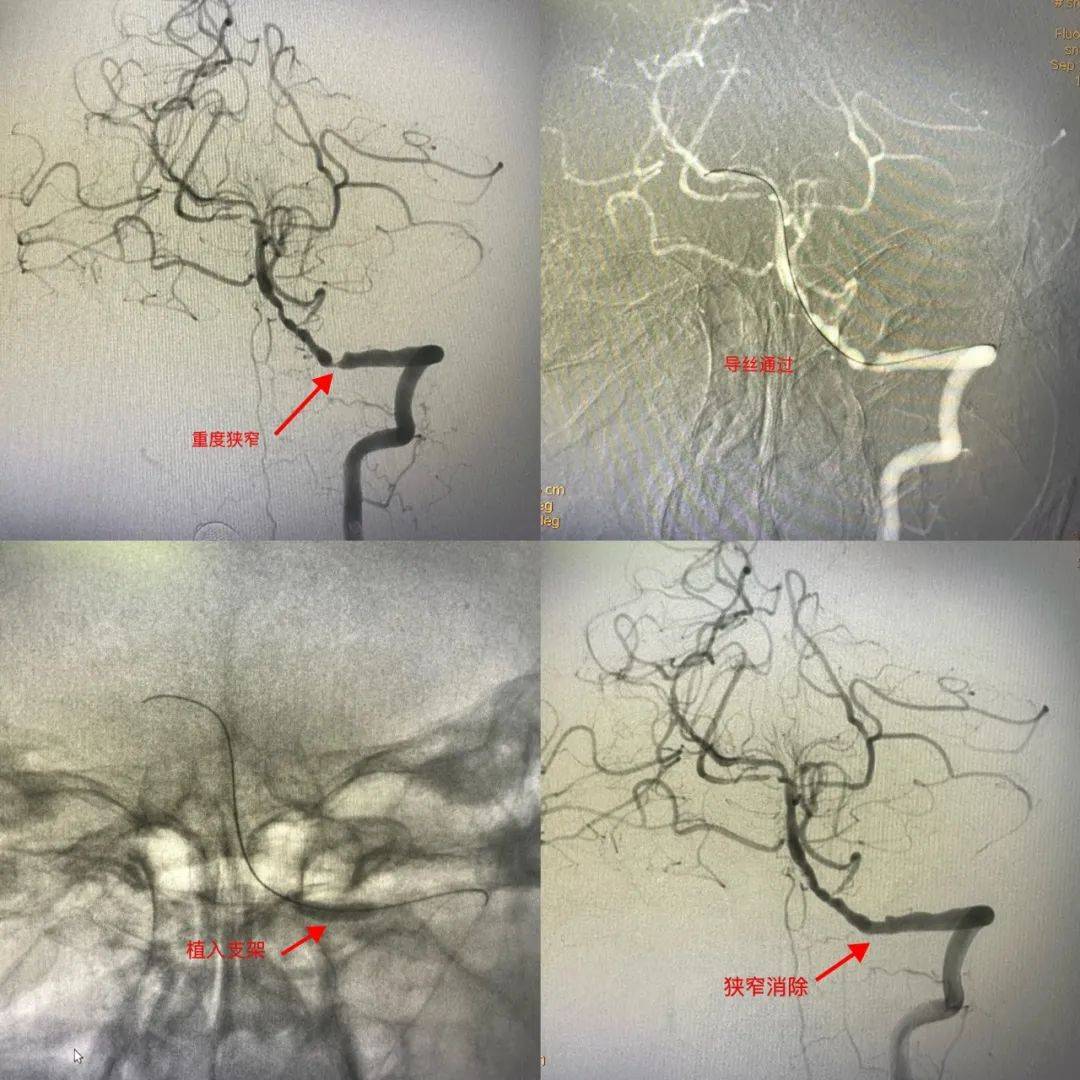 脑血管支架手术过程图片
