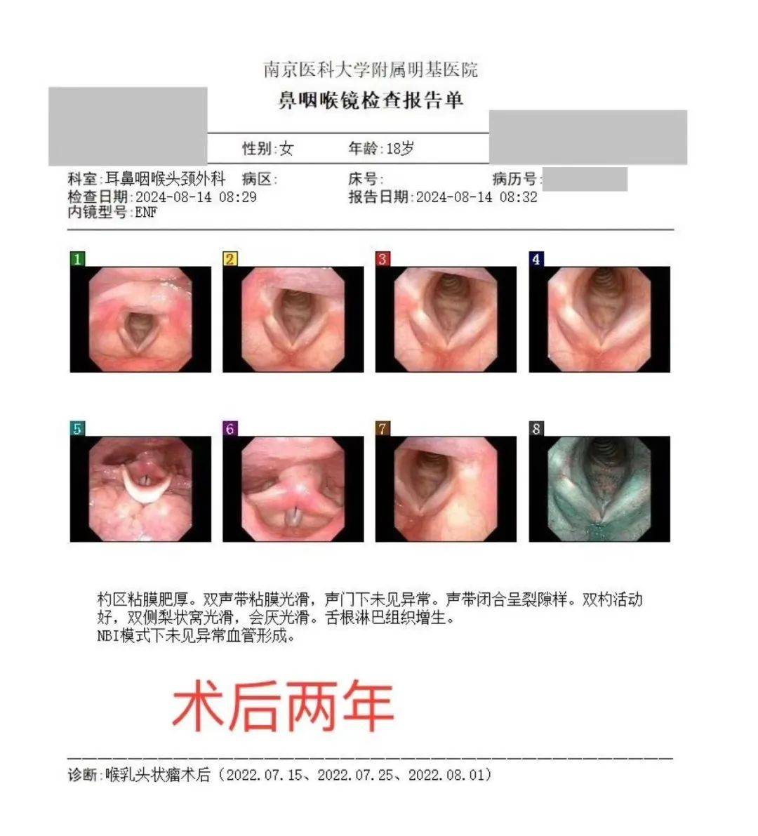 喉镜会厌图片图片