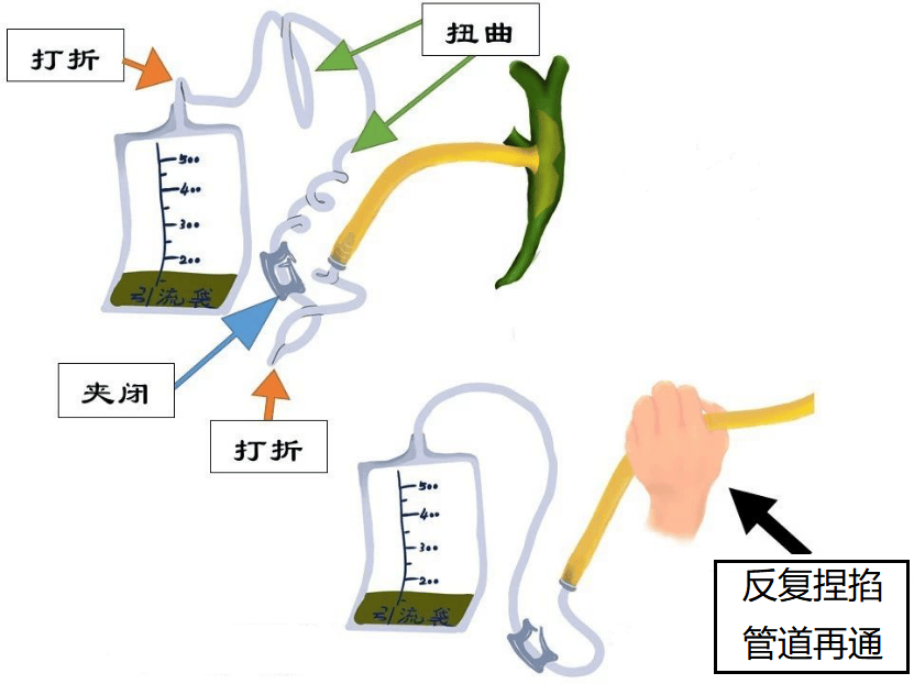 引流管卡通图图片