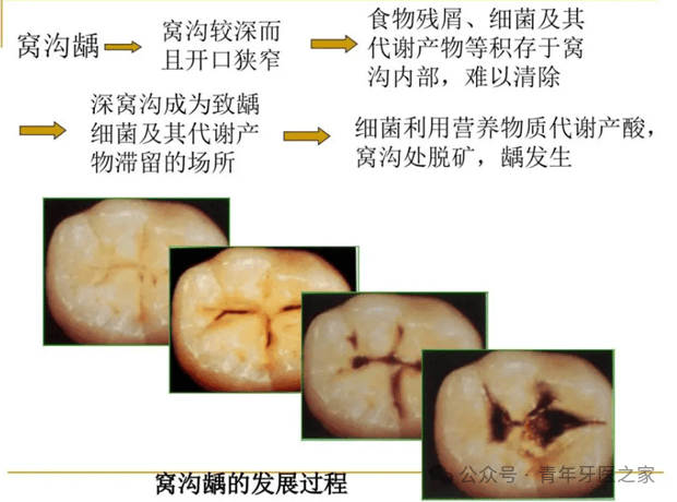 牙齿龋坏过程图片