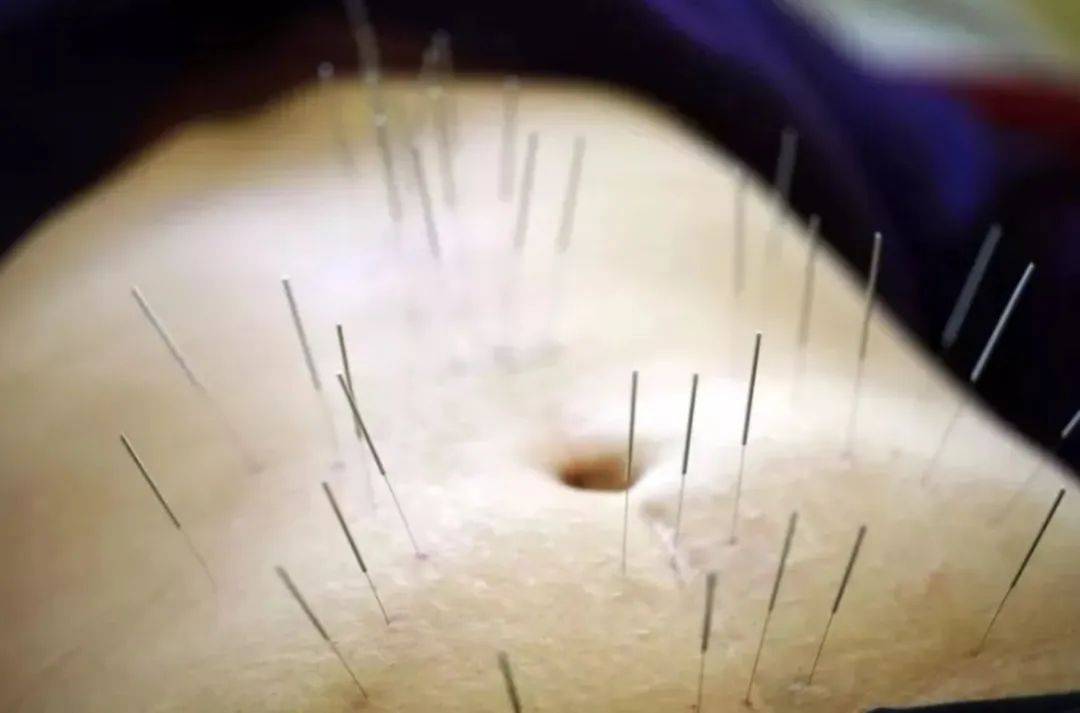 安全!高效!腹针疗法