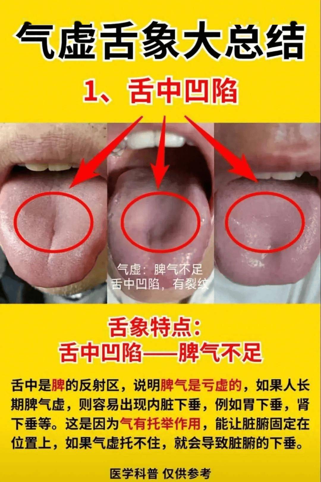 舌头中间有凹陷图片