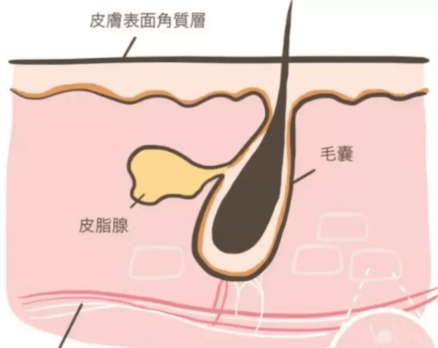 毛囊皮脂腺炎症怎么治图片