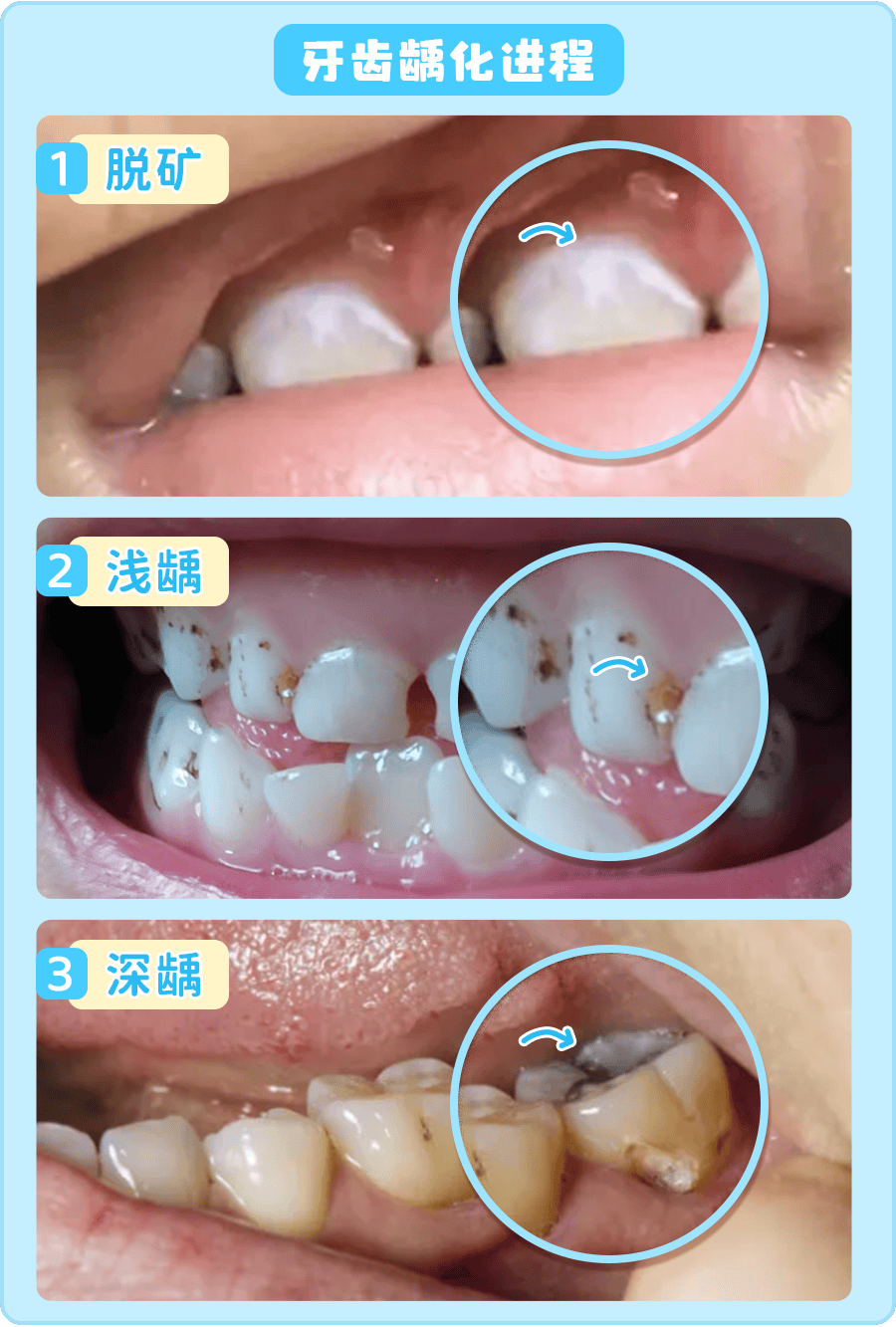 牙根腐烂怎么办图片