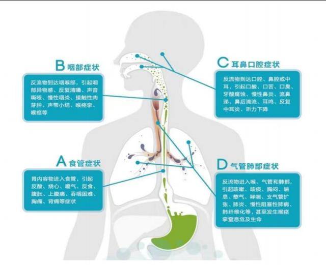 看潍坊市第二人民医院胃食管反流如何治疗(图1)