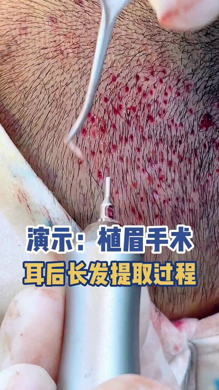 演示:植眉手术,耳后长发提取过程植眉 眉毛种植 江华医生团队 夏季