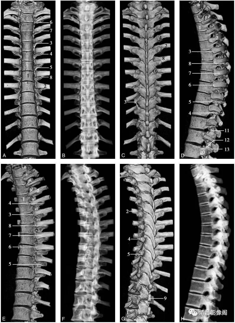 胸椎ct解剖及常见变异
