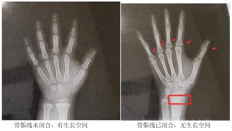 尺桡骨闭合图片图片