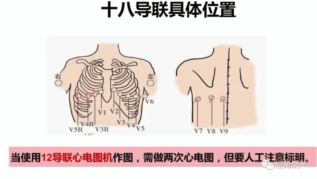 心电图18导联怎么做图片