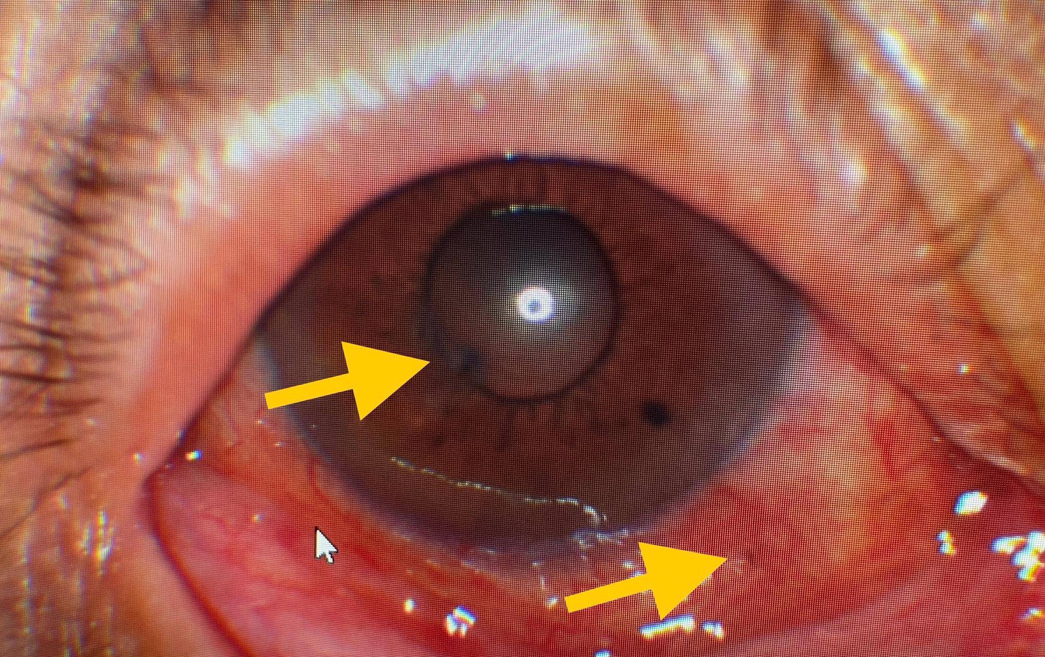 下出现片状出血,且有多根板栗刺插入巩膜和角膜,部分刺甚至穿过了前房